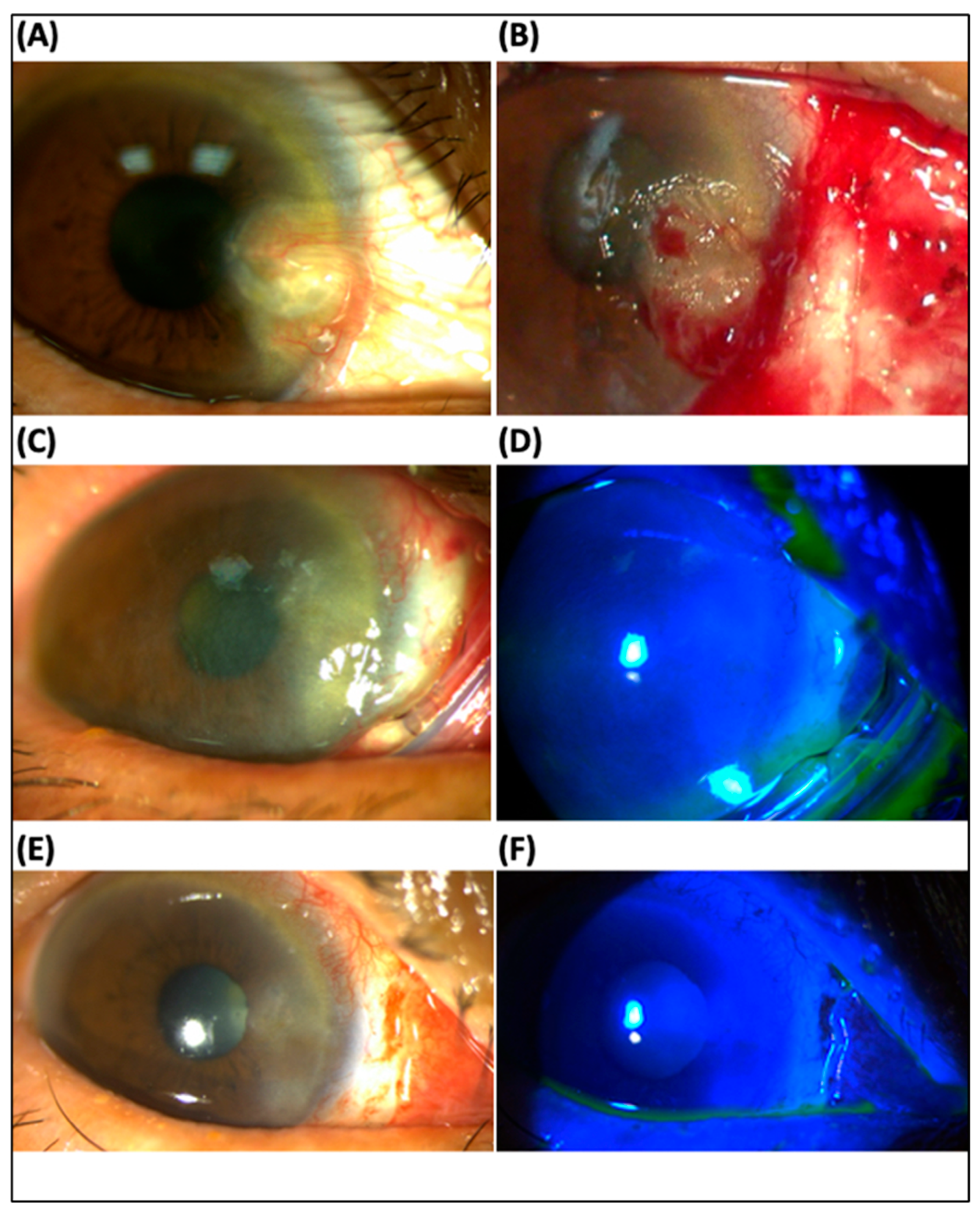 Ocular Instillation of Cyanoacrylate Adhesive: A Case Report EMRA