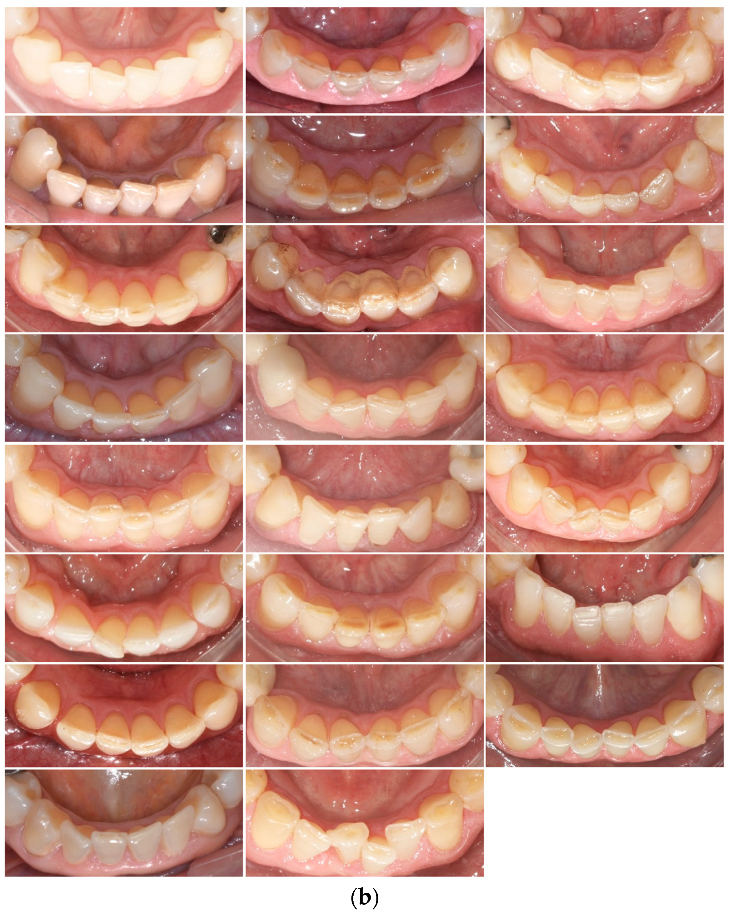 | Age Subjects of Pioneering JCM | Occlusion: Erosive Normal Free Tooth in Study the Longitudinal with Wear A to up 60 Full-Text