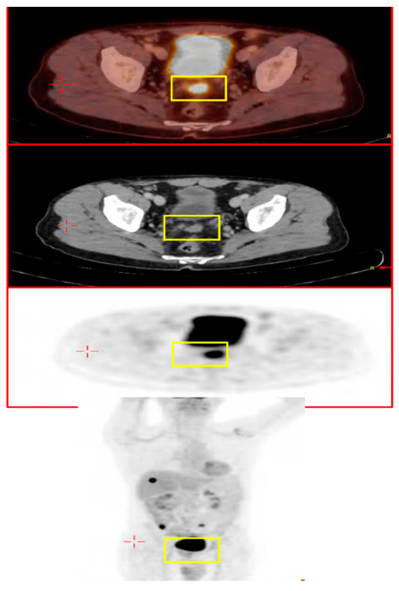 The Role of PET Scans in the Diagnosis and Treatment of Cancer -  CancerConnect