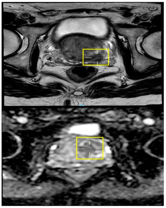 The Role of PET Scans in the Diagnosis and Treatment of Cancer -  CancerConnect