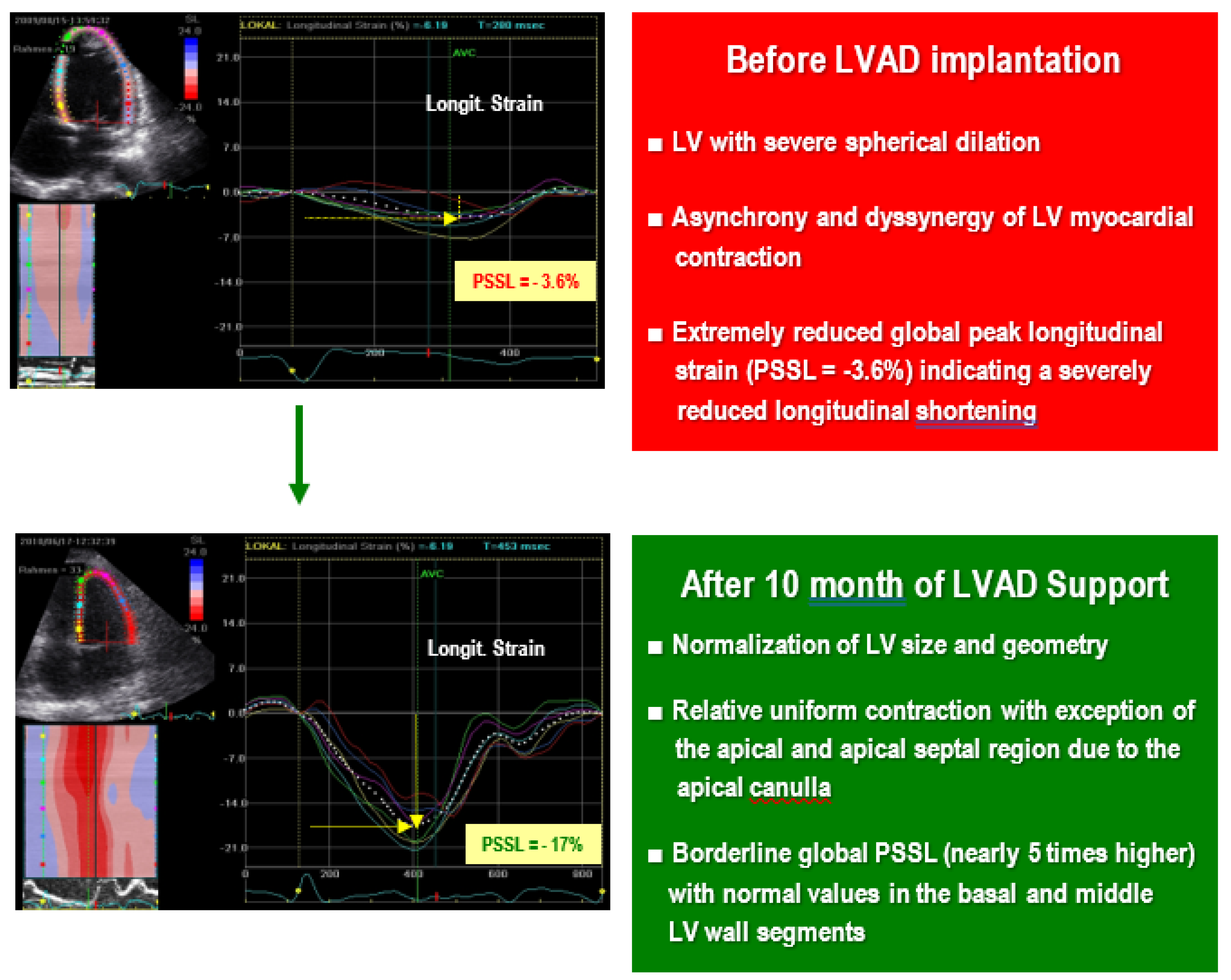 Reduced global longitudinal strain is associated with increased