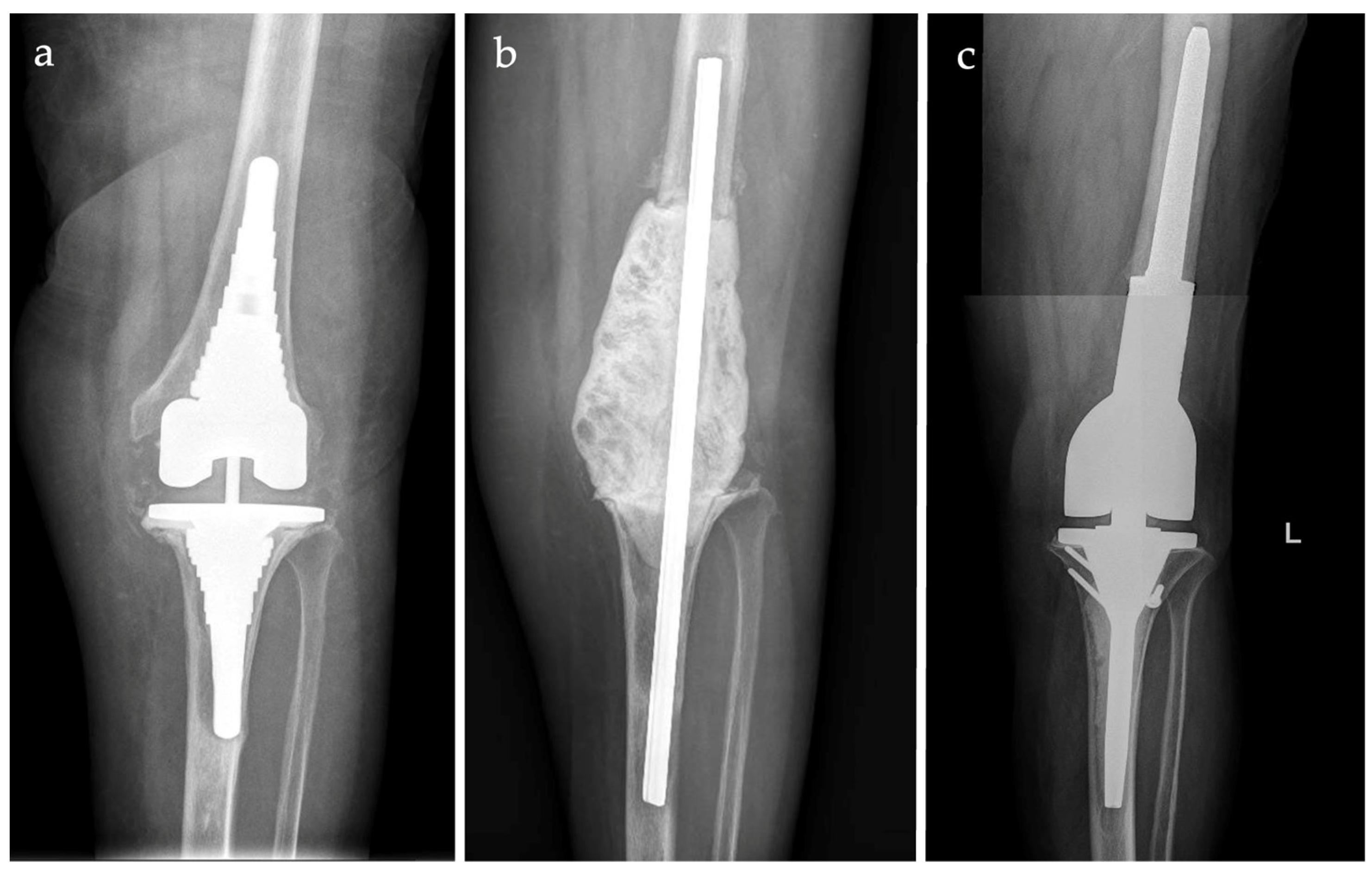 JCM | Free Full-Text | Silver-Coated Distal Femur Megaprosthesis