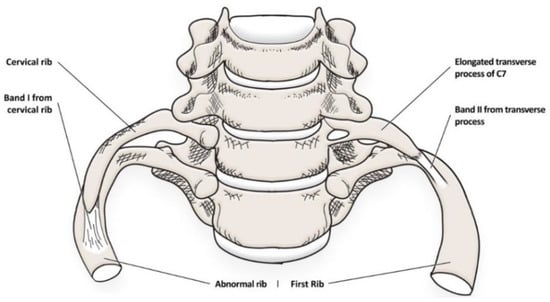 Costoclavicular space compression (Image source: Watson et al