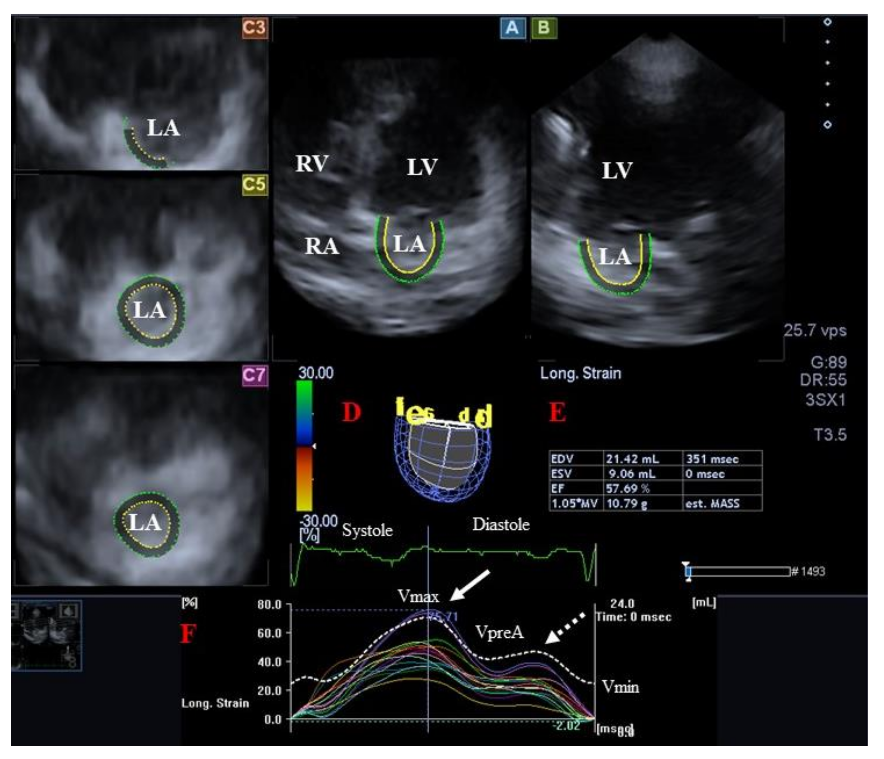 Dilated Cardiomyopathy in Acromegaly: a Case Report with Cardiac MR Findings