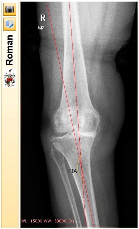 FUNCTIONAL KNEE BRACE WITH UNILATERAL JOINT AND F/E