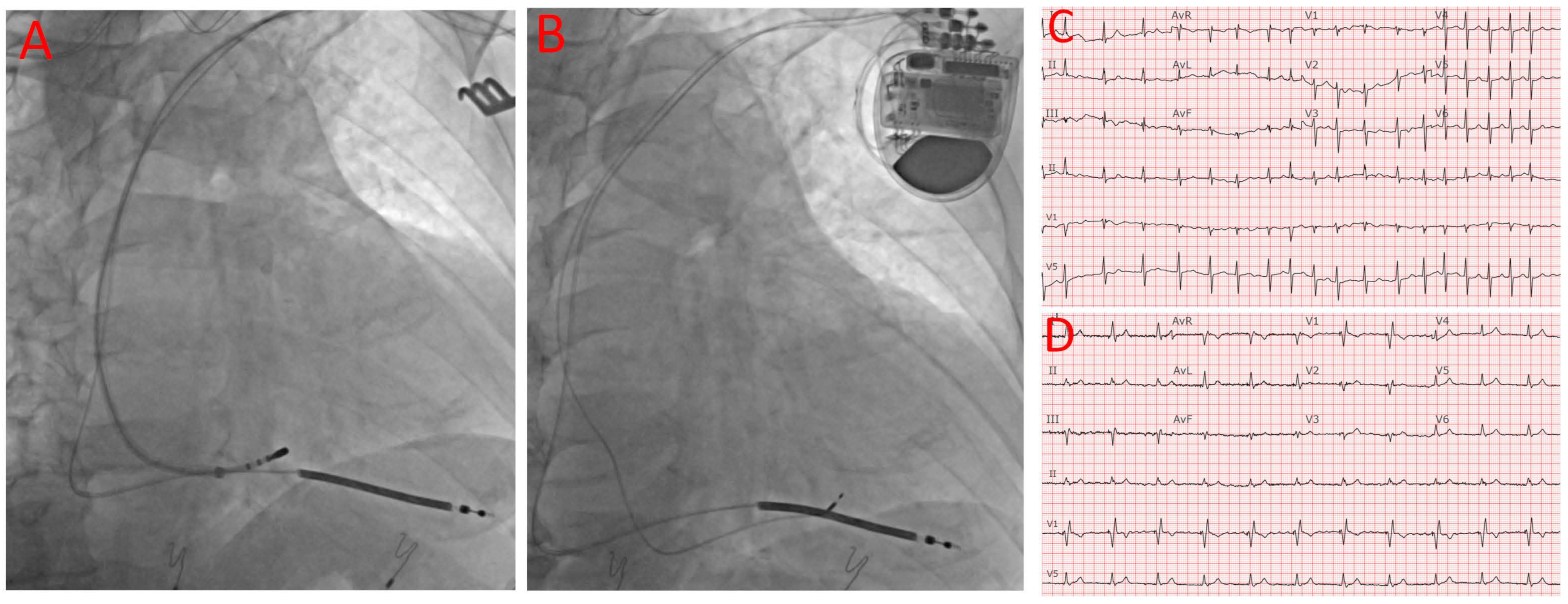 Combining aesthetics and feasibility in chest port placement