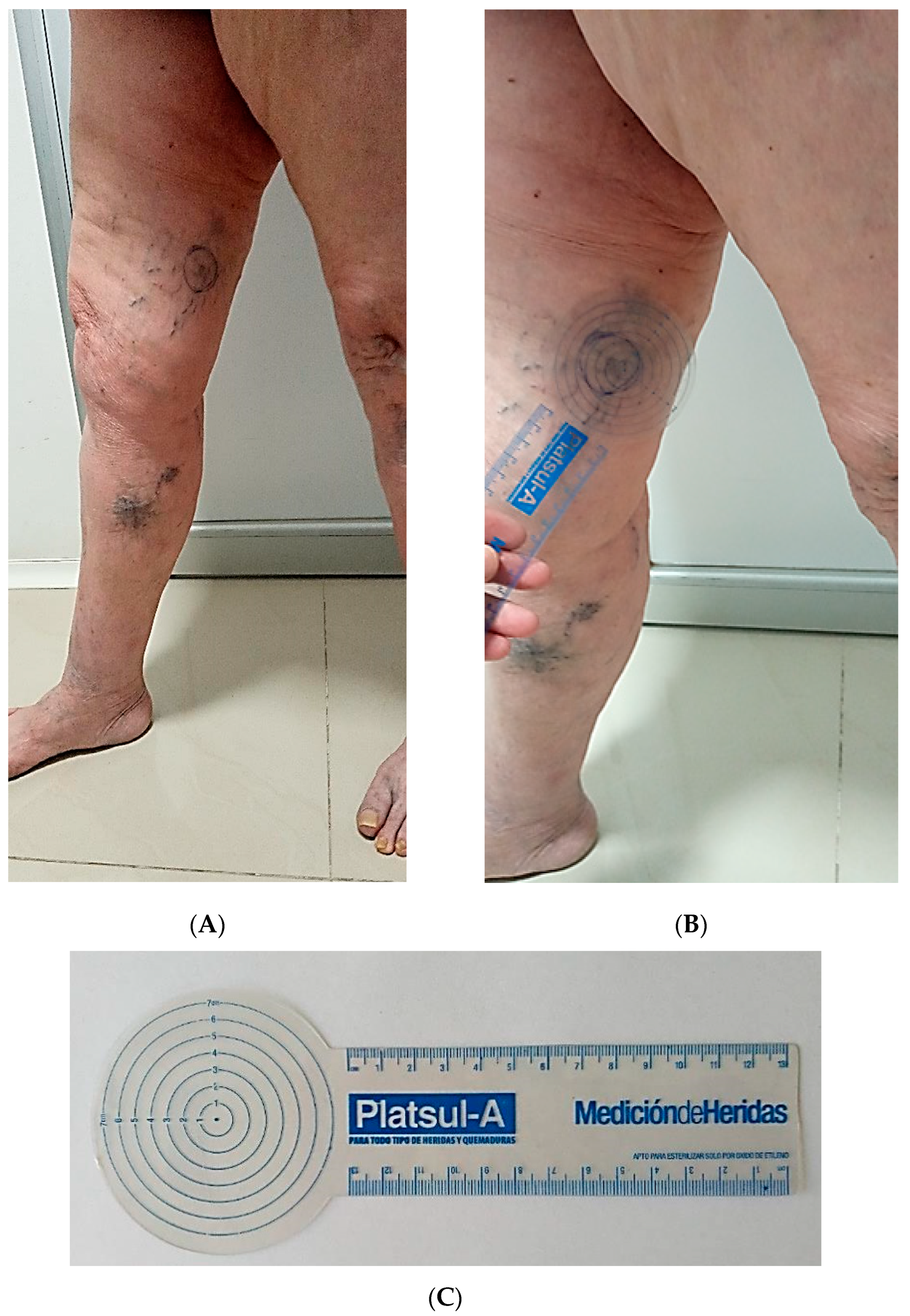 18 Year Old Student Treated for Varicose Veins