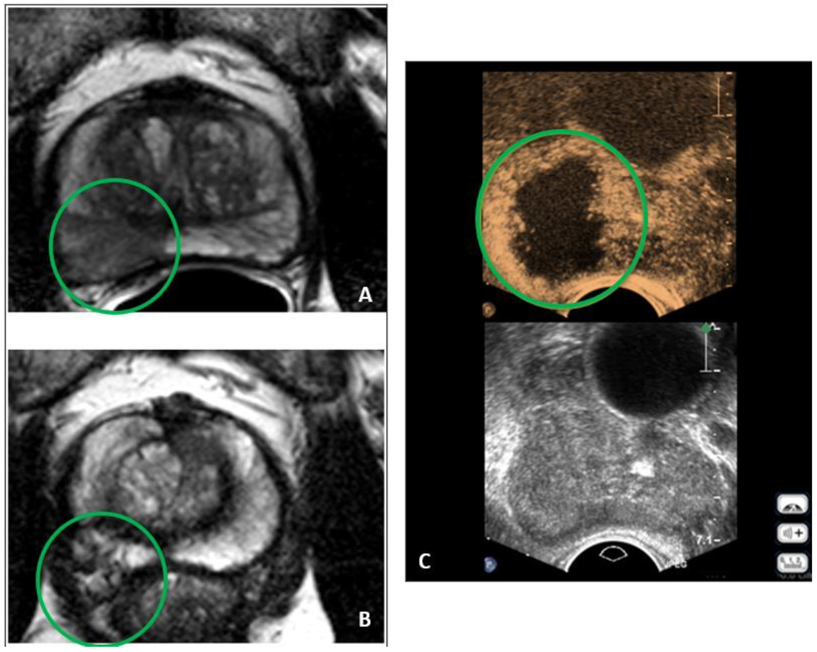 Treatment of Post, High-Intensity-Focused Ultrasound Urethral