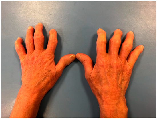 Osteoarthritis Hand