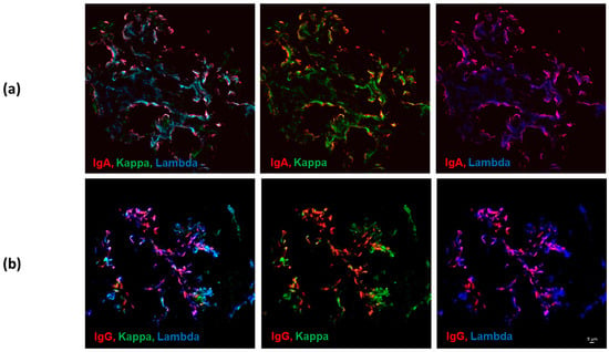 JCM | Free Full-Text | Colocalization of IgG and IgA Heavy Chains with Kappa  and Lambda Light Chains in Glomerular Deposits of IgA Nephropathy Patients  Using High-Resolution Confocal Microscopy and Correlation with