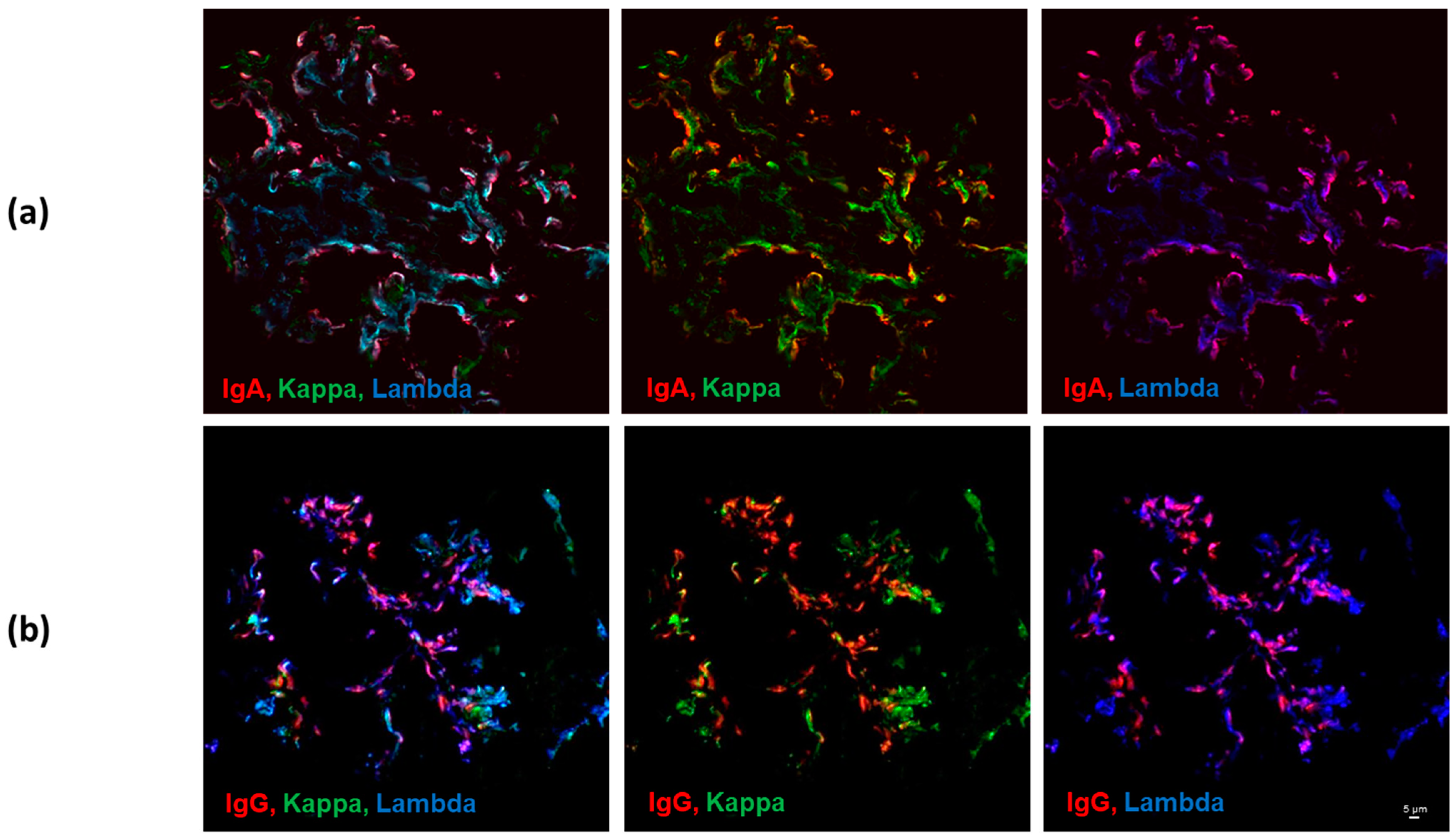 JCM | Free Full-Text | Colocalization of IgG and IgA Heavy Chains with Kappa  and Lambda Light Chains in Glomerular Deposits of IgA Nephropathy Patients  Using High-Resolution Confocal Microscopy and Correlation with