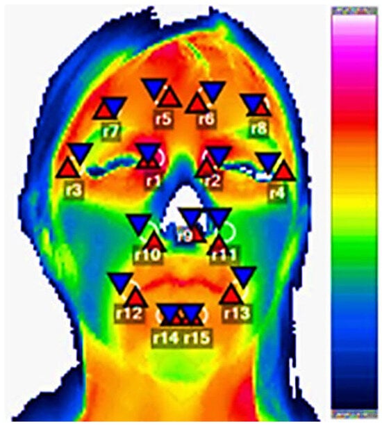 JCM Free Full Text Exploring Facial Thermography Patterns in