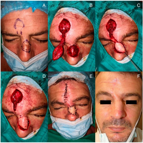 paramedian forehead flap before and after