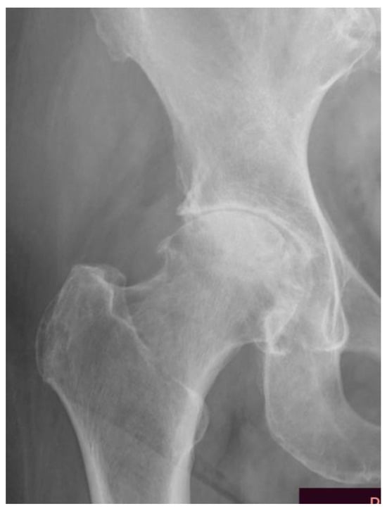 JCM | Free Full-Text | Level of Disability after Total Hip Replacement ...