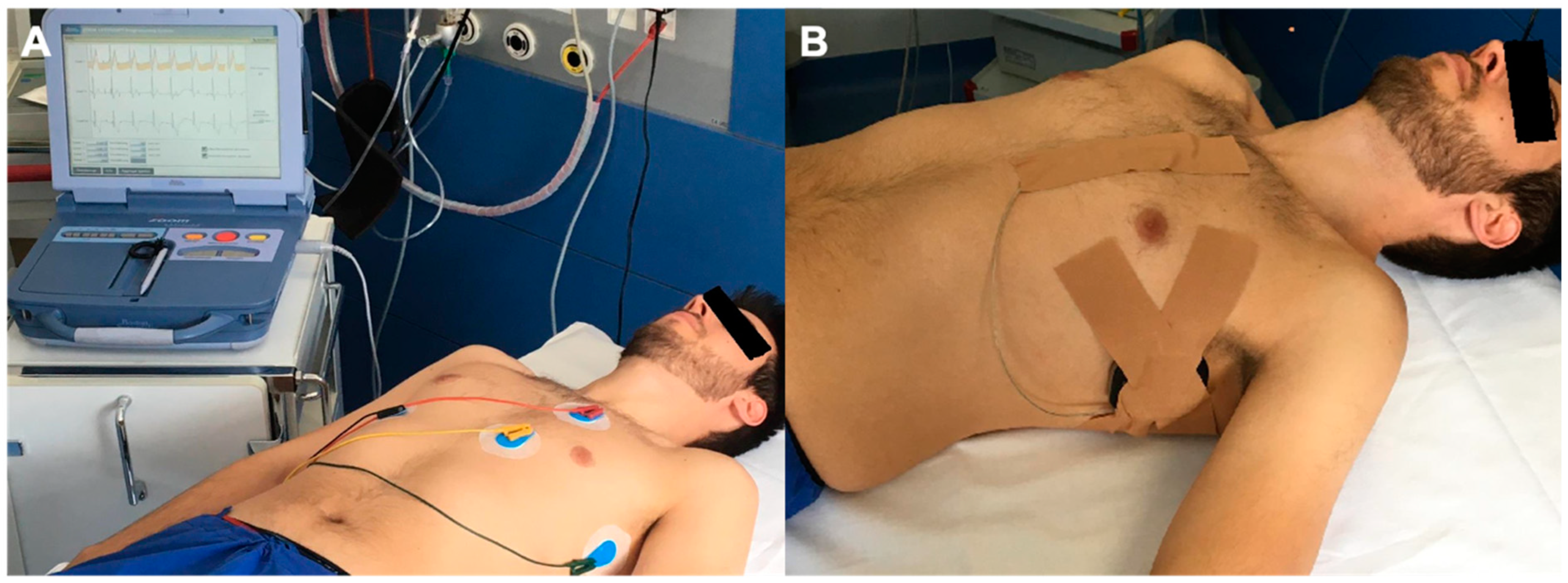 JCM | Free Full-Text | Safety and Performance of the Subcutaneous  Implantable Cardioverter Defibrillator Detection Algorithm INSIGHTTM in  Pacemaker Patients