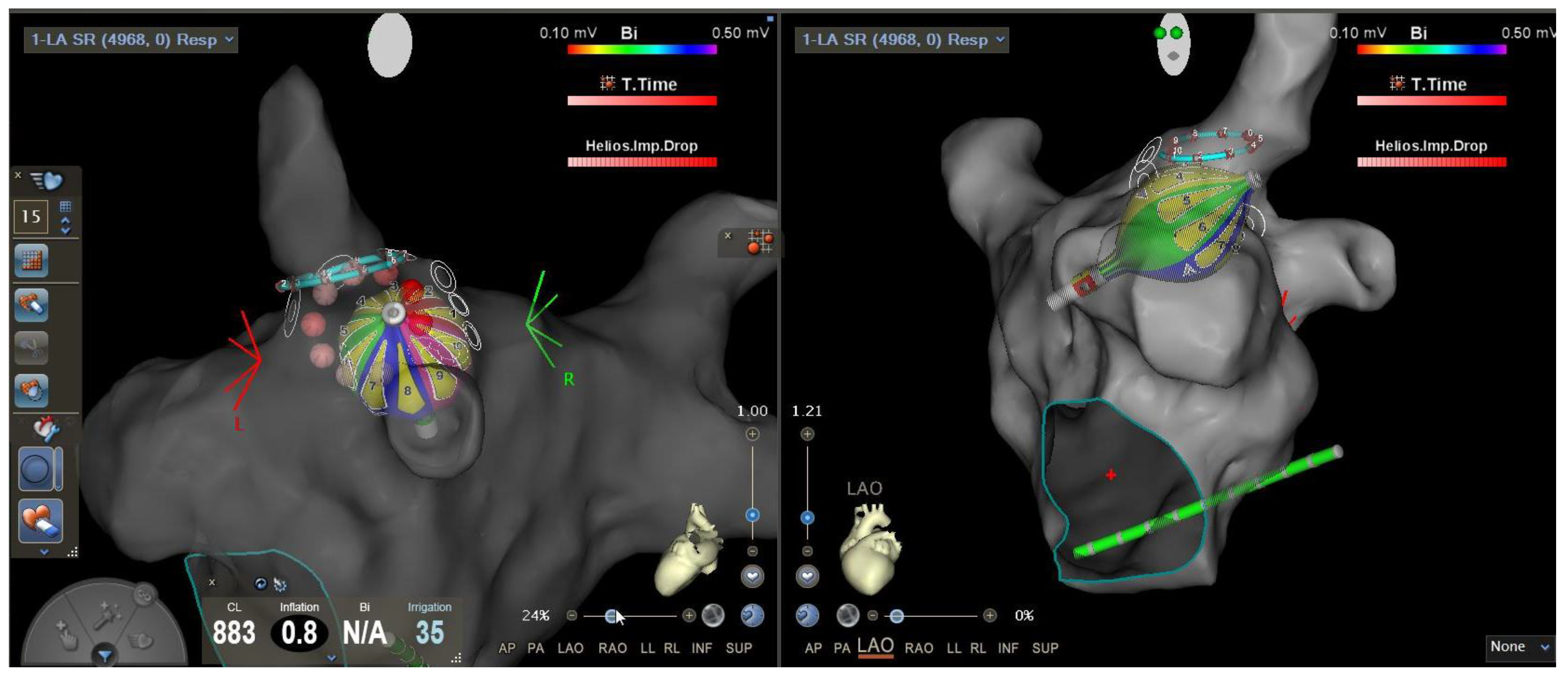 High-Power Short Duration Ablation for Pulmonary Vein Isolation