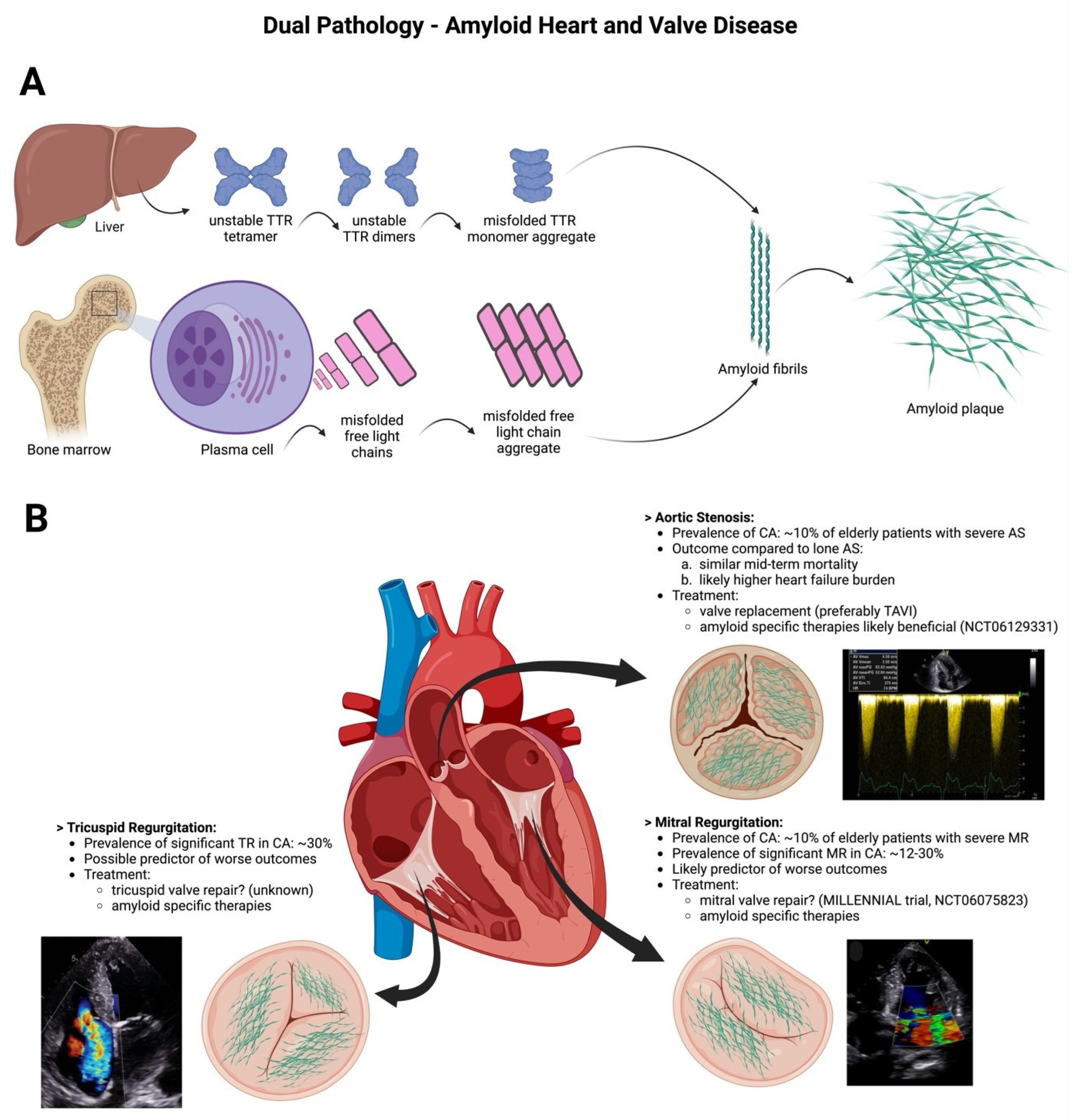 JCM | Free Full-Text | Cardiac Amyloidosis and Valvular Heart Disease