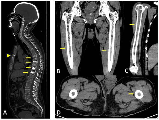 Frontiers  Deep learning assessment compared to radiologist reporting for  metastatic spinal cord compression on CT