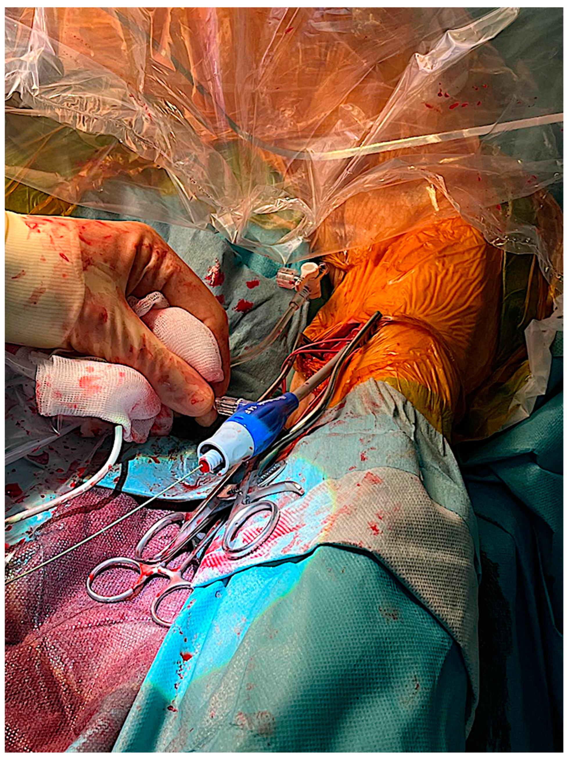 Femoral hernia in the era of TAVI – a potential obstacle for