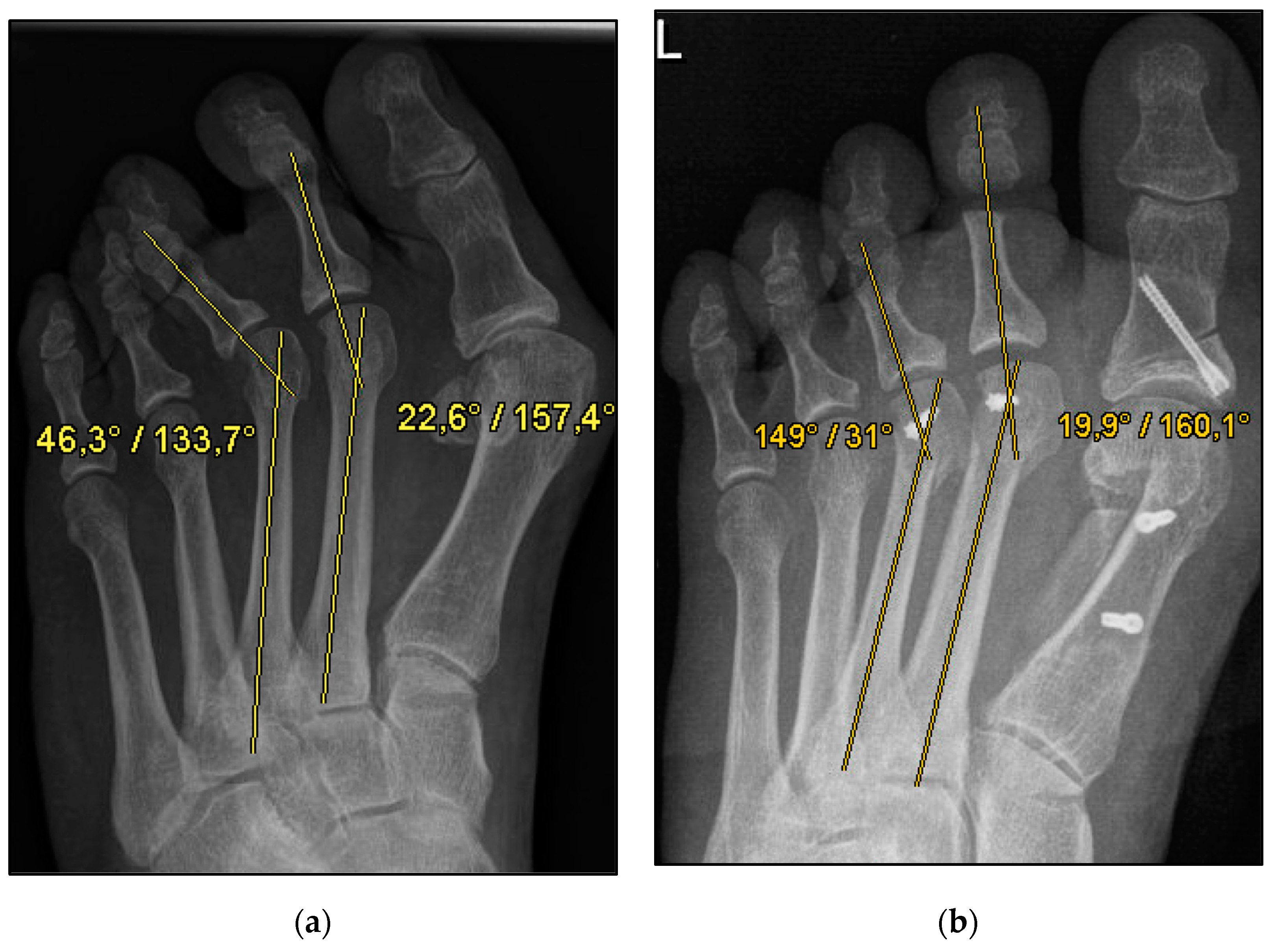 File:X-ray of a normal foot of a 12 year old male - dorsoplantar