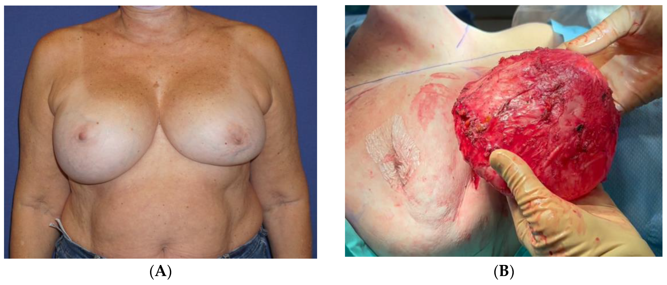 Breast Implant-Associated Anaplastic Large Cell Lymphoma (BIA-ALCL)