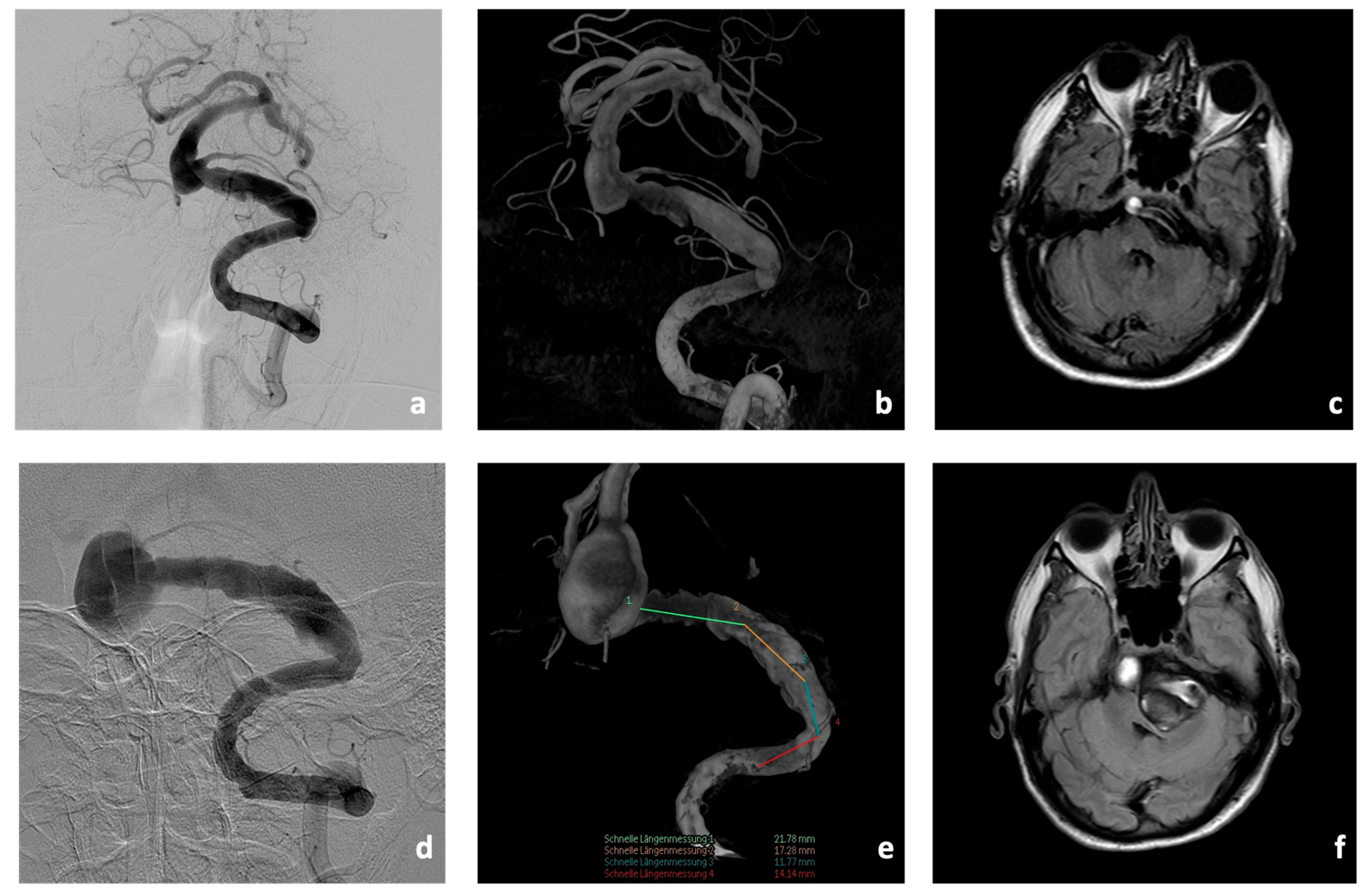 JCM | Free Full-Text | A Giant Stent for Giant Cerebral