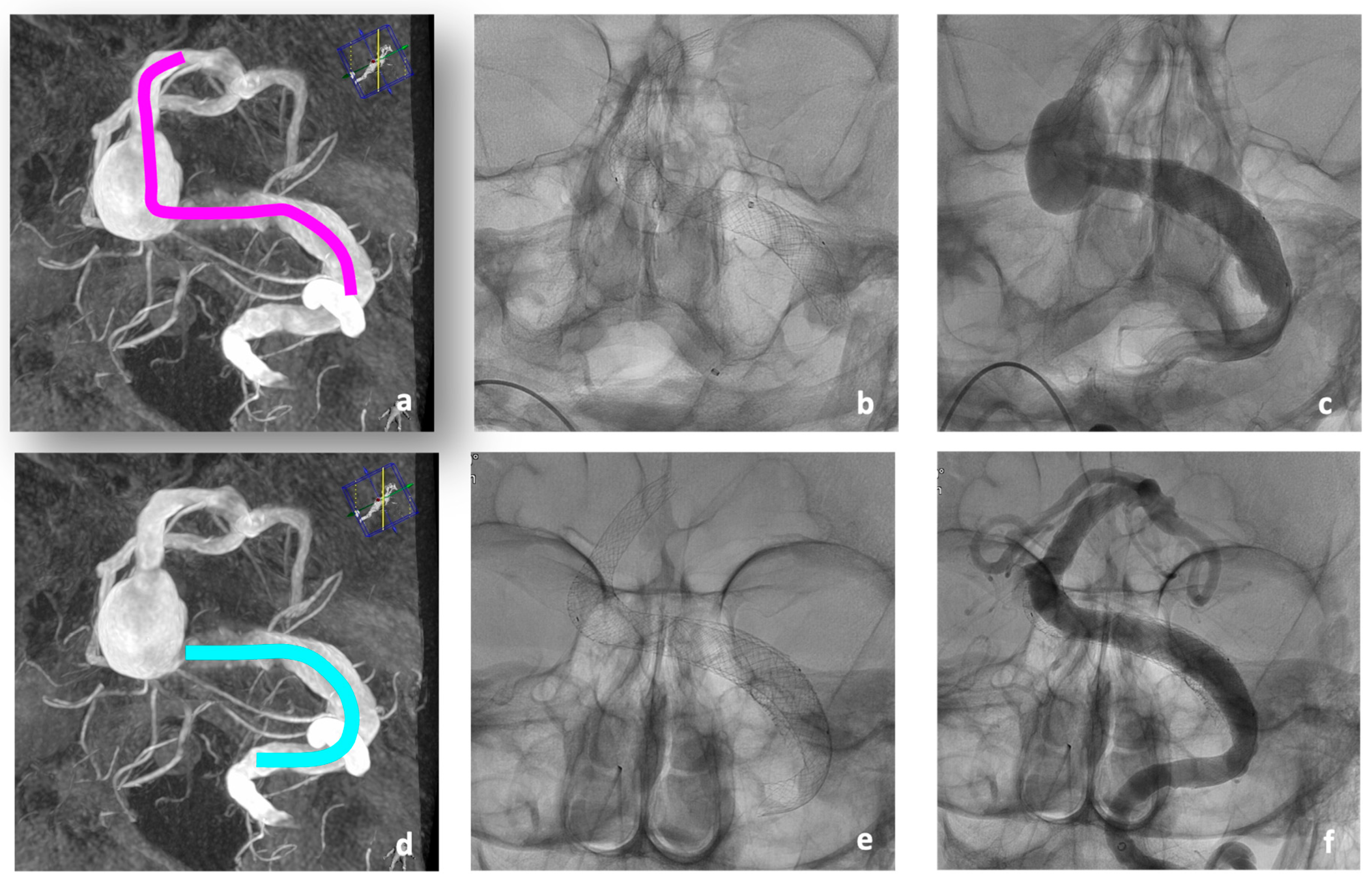 JCM | Free Full-Text | A Giant Stent for Giant Cerebral