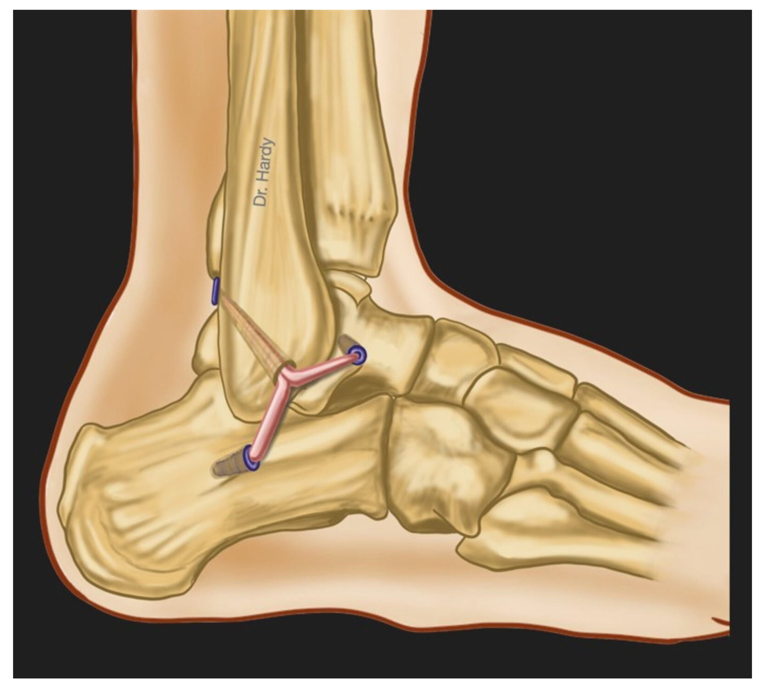 Ankle Instability El Paso  Ankle Ligament Injury El Paso