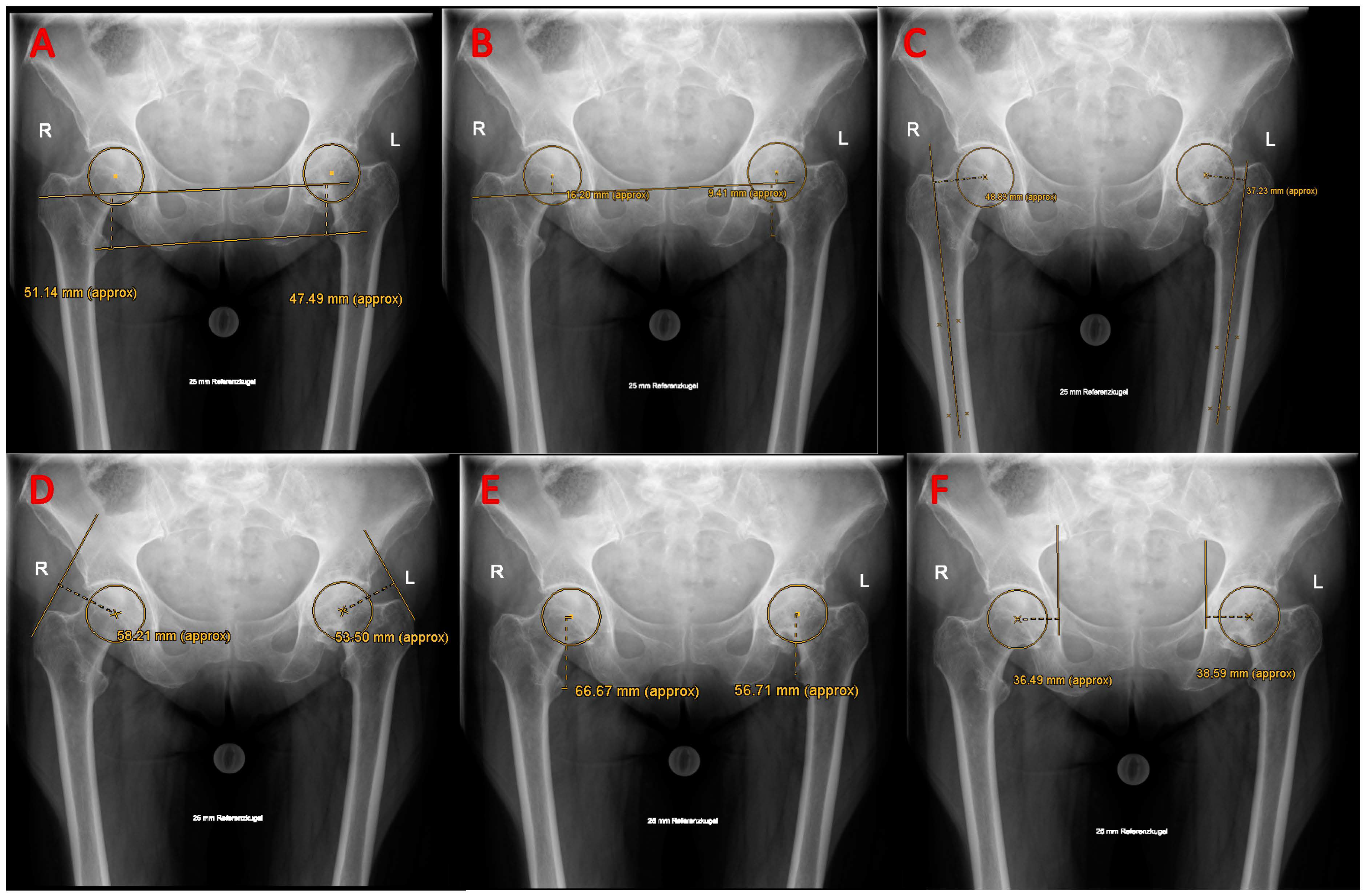 Studies Confirm Benefits of Direct Anterior Approach to Total Hip