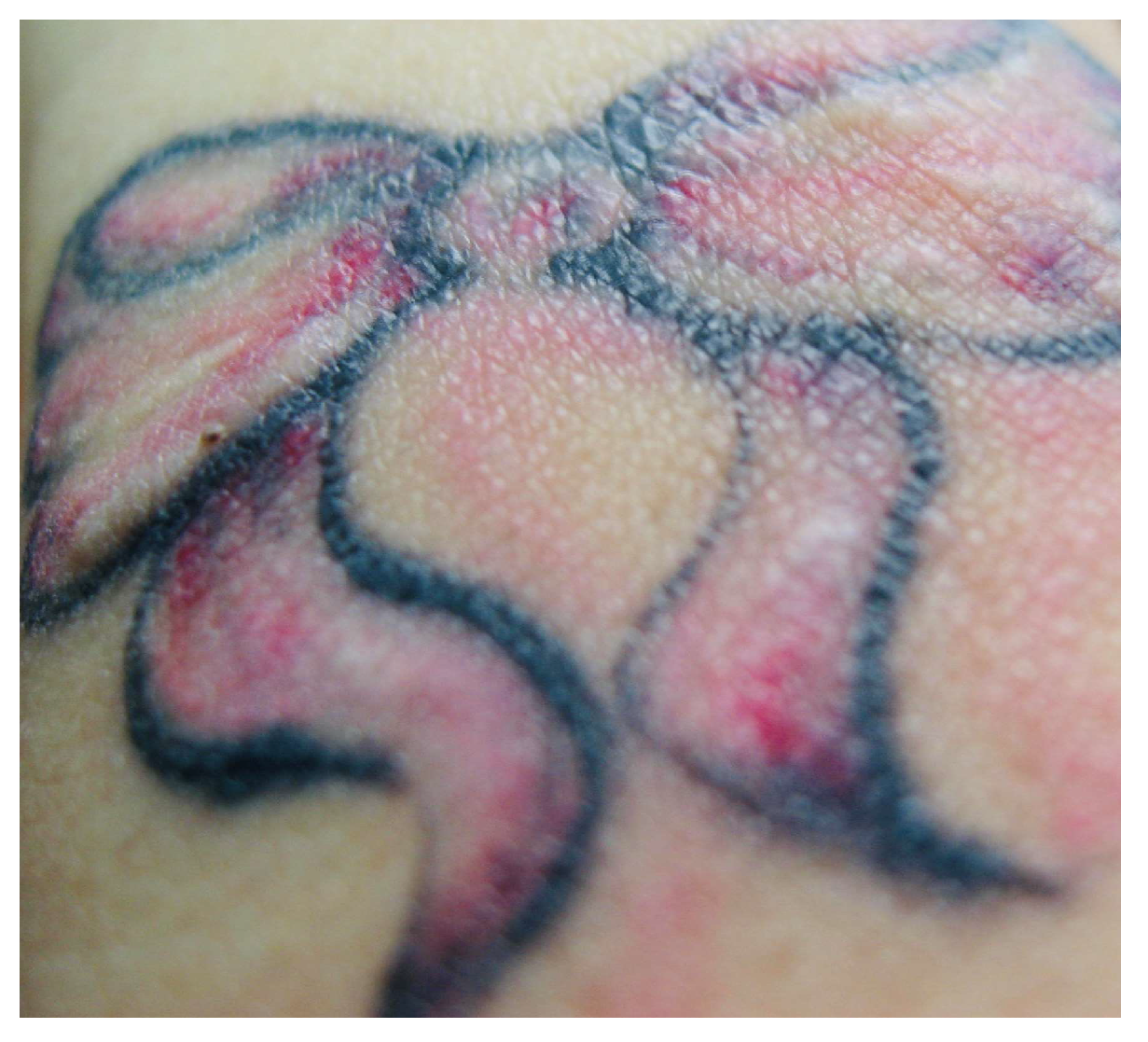 Figure 3 from Diagnostic Tools for Doctors' Evaluation of Tattoo  Complications. | Semantic Scholar