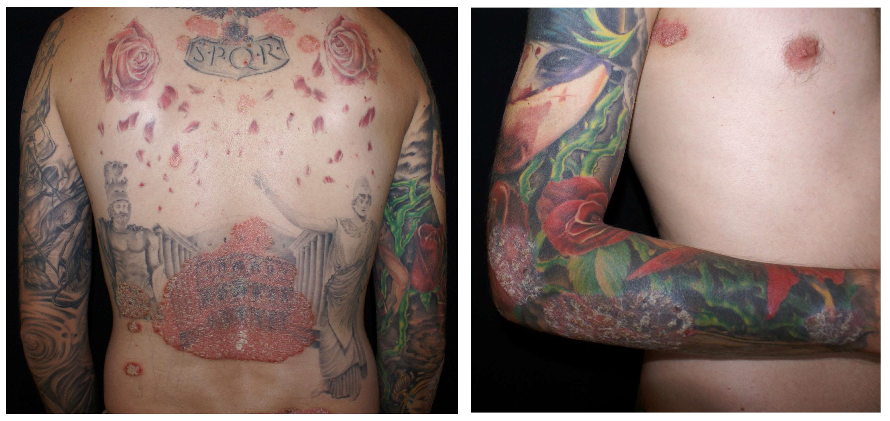 Efficient removal of black henna tattoos
