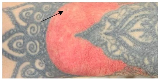 Figure 2 from Successful removal of hyperkeratotic-lichenoid reaction to  red ink tattoo with preservation of the whole tattoo using a skin grafting  knife. | Semantic Scholar