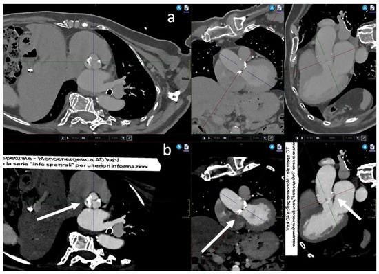 Reduction of contrast medium for transcatheter aortic valve replacement  planning using a spectral detector CT: a prospective clinical trial