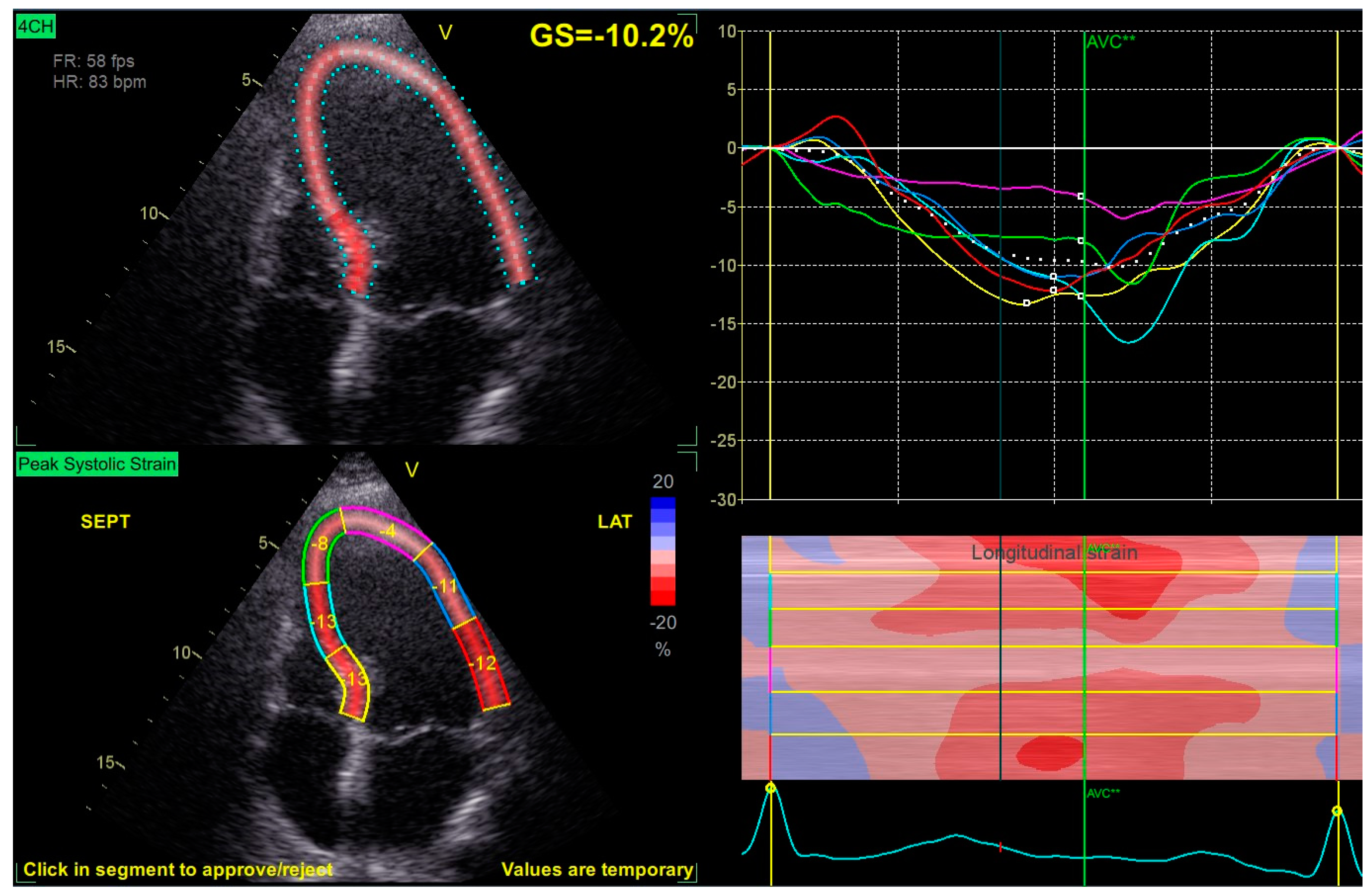 JCM Free Full Text Reverse Septal Movement A Step Forward in