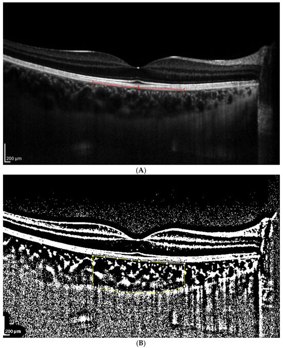 JCM Free Full Text Impact of Brightness on Choroidal