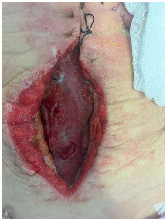 Vaginal mass with necrotic appearance obstructing the vaginal introitus.