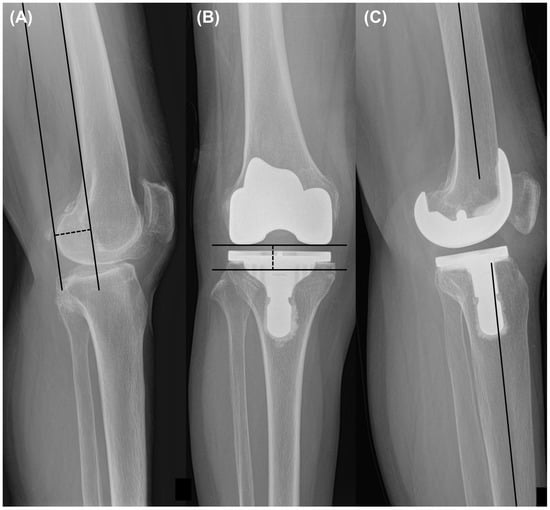 Influence of intentional femoral component flexion in navigated