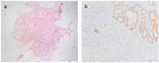 The Relationship between Tumor Budding and Tumor Deposits in Patients ...