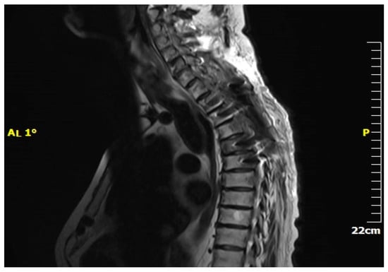 JCM | Free Full-Text | Comprehensive Insights into Metastasis ...