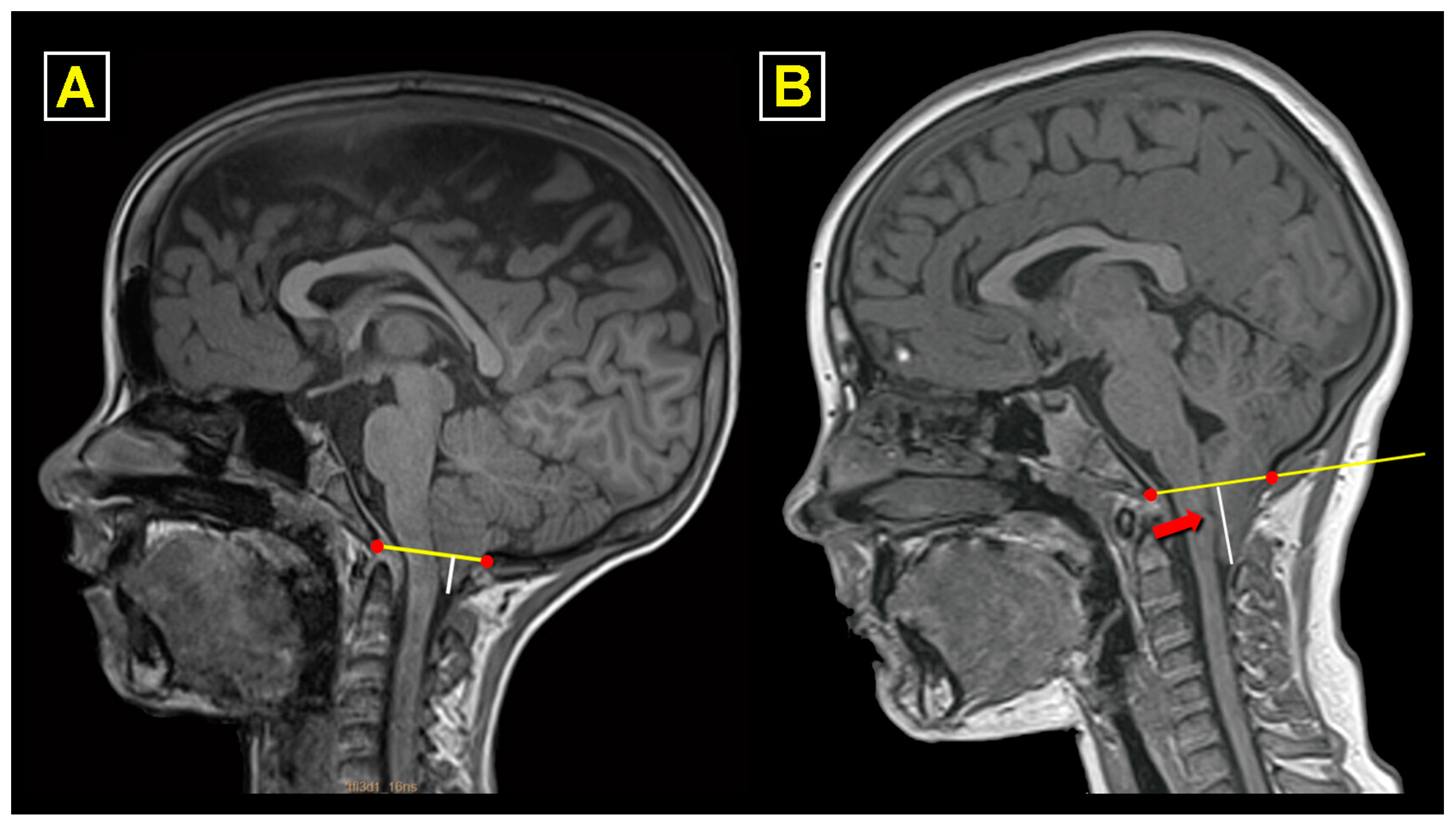 JCM Free Full Text Surgical Outcomes in Chiari 1 and Chiari  