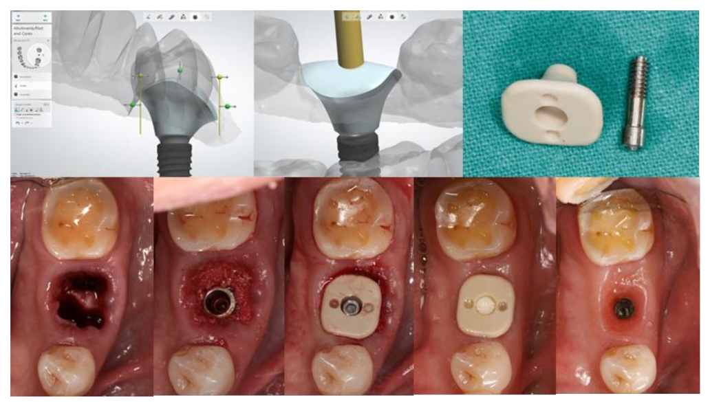 JFB | Free Full-Text | Biomaterials and Clinical Applications of Customized  Healing Abutment&mdash;A Narrative Review