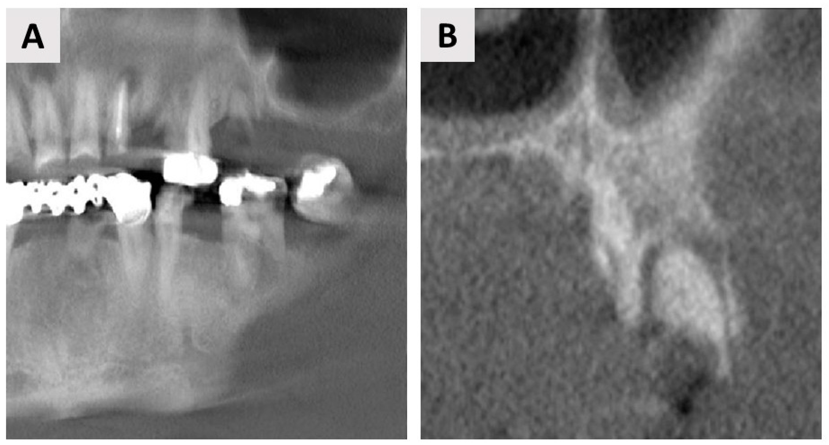 Guided Bone Regeneration Using a Novel Magnesium Membrane: A Literature ...