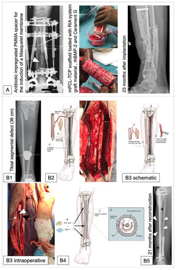 PDF) Custom-Made Synthetic Scaffolds for Bone Reconstruction: A  Retrospective, Multicenter Clinical Study on 15 Patients