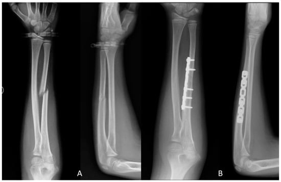 Jfmk Free Full Text Locked Intramedullary Nailing Versus Compression Plating For Stable Ulna Fractures A Comparative Study Html