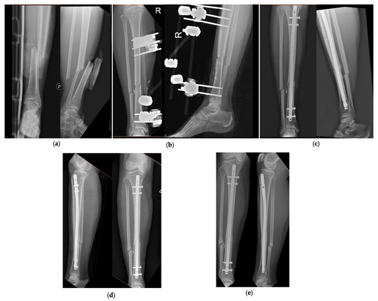 KNEE PERIPROSTHETIC FRACTURES IN THE ELDERLY: CURRENT CONCEPT | Published  in Orthopedic Reviews