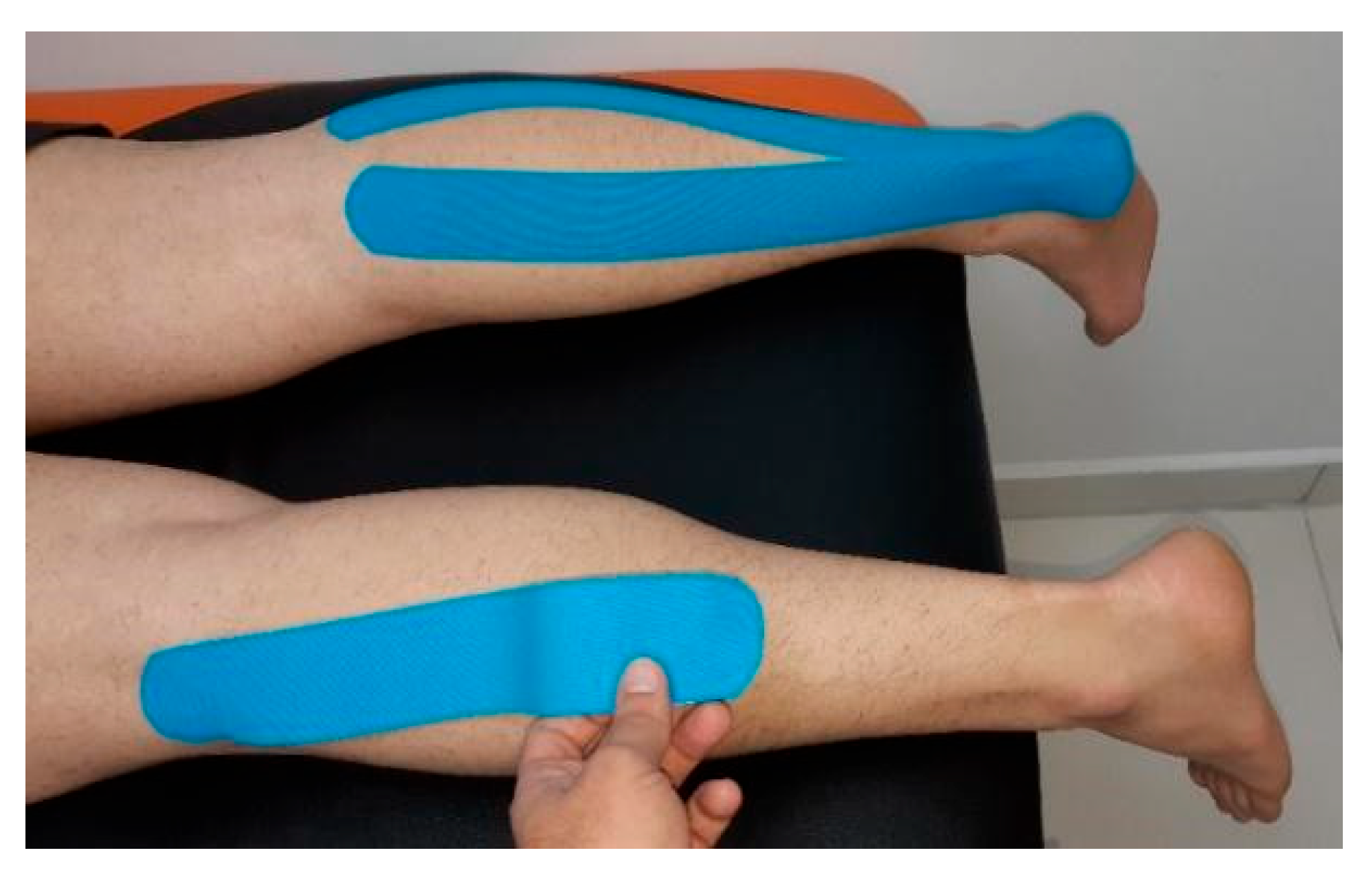 A) Application of Kinesio tape to the rectus femoris muscle. (B