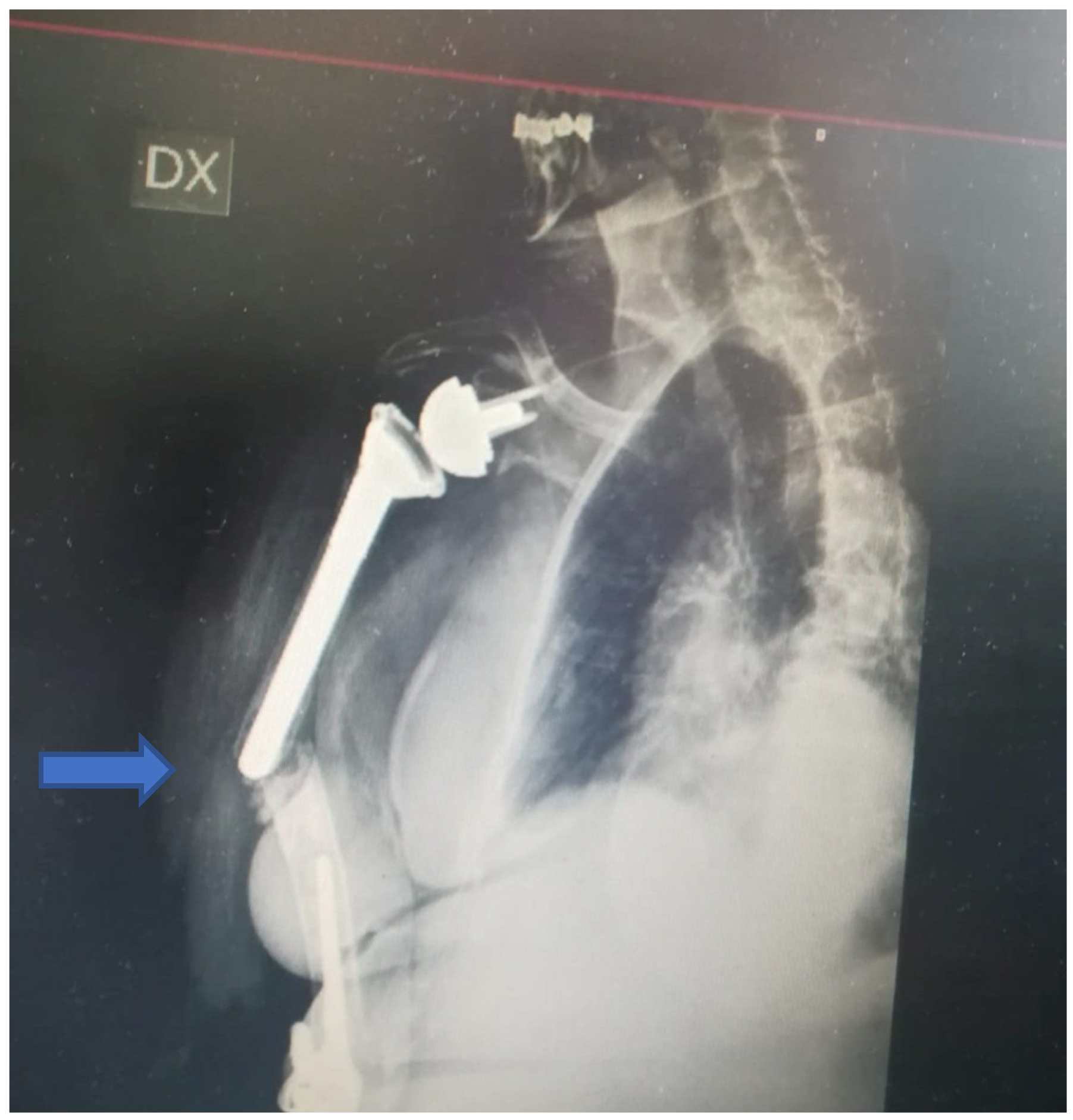 Plate osteosynthesis combined with bone cement provides the