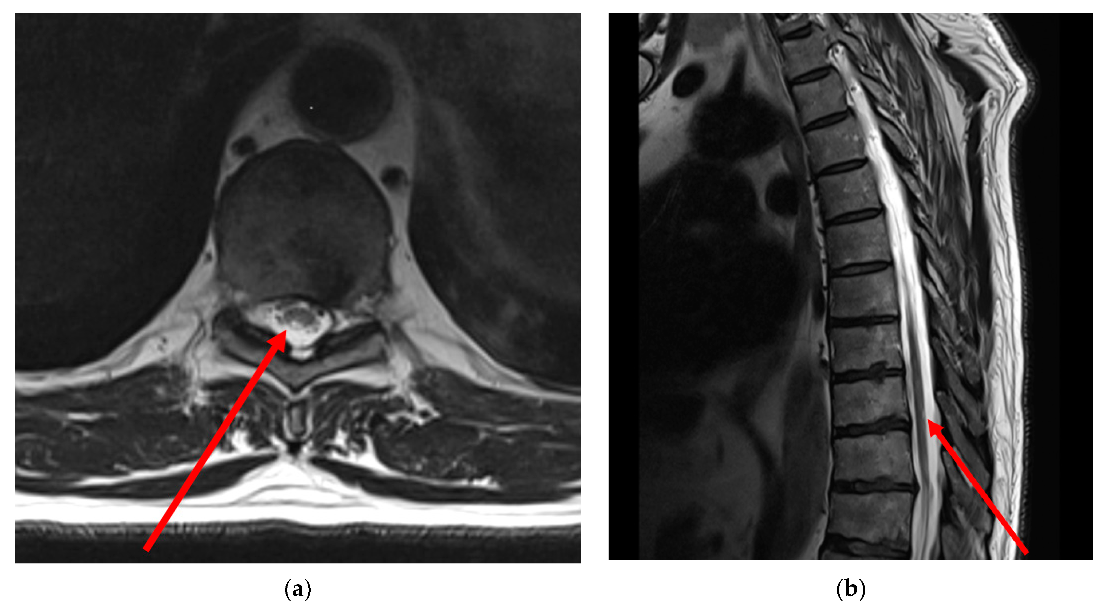 Cureus  Complex Compression Fracture in the Thoracolumbar