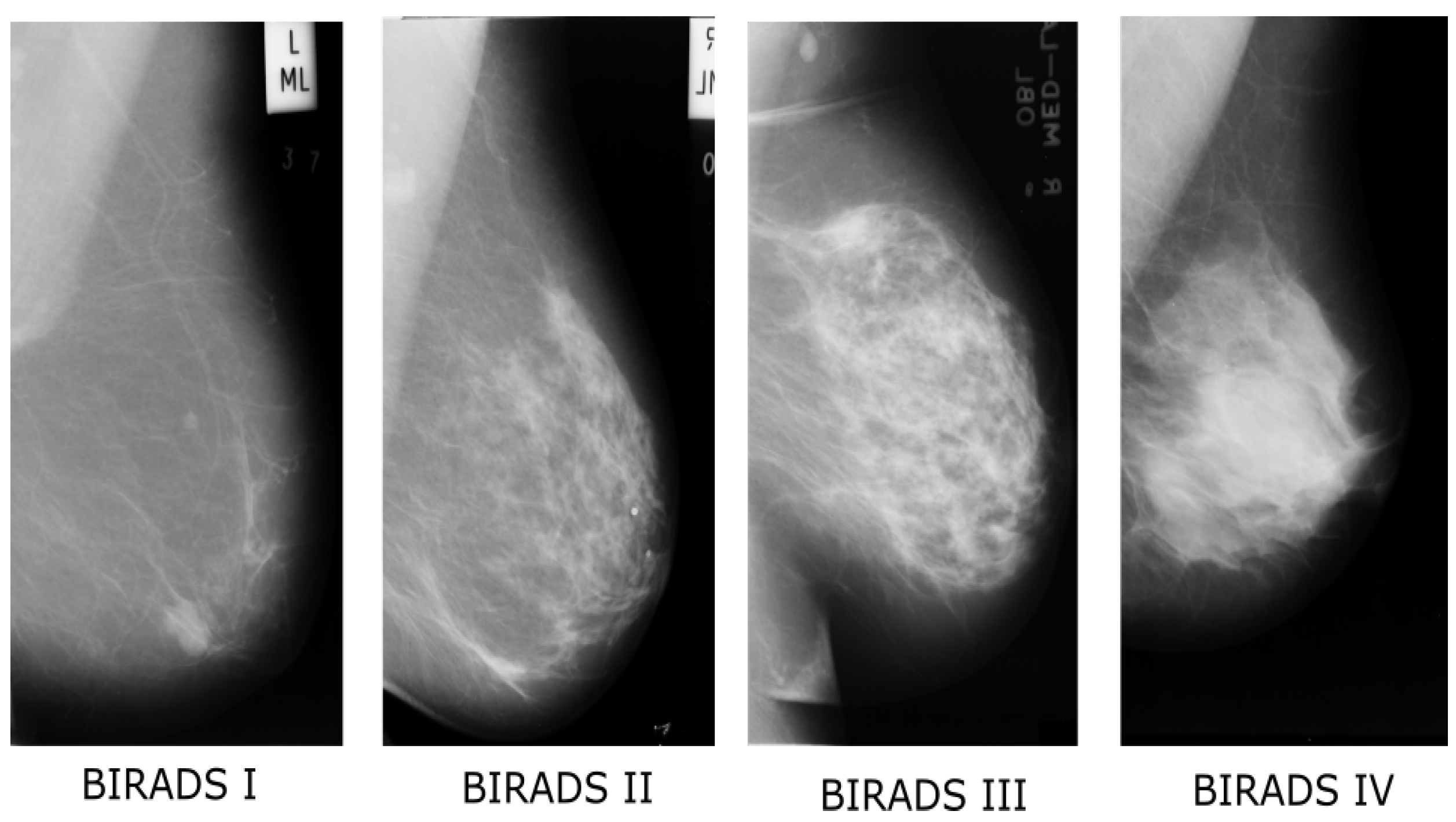 Маммография молочных желез bi rads 4