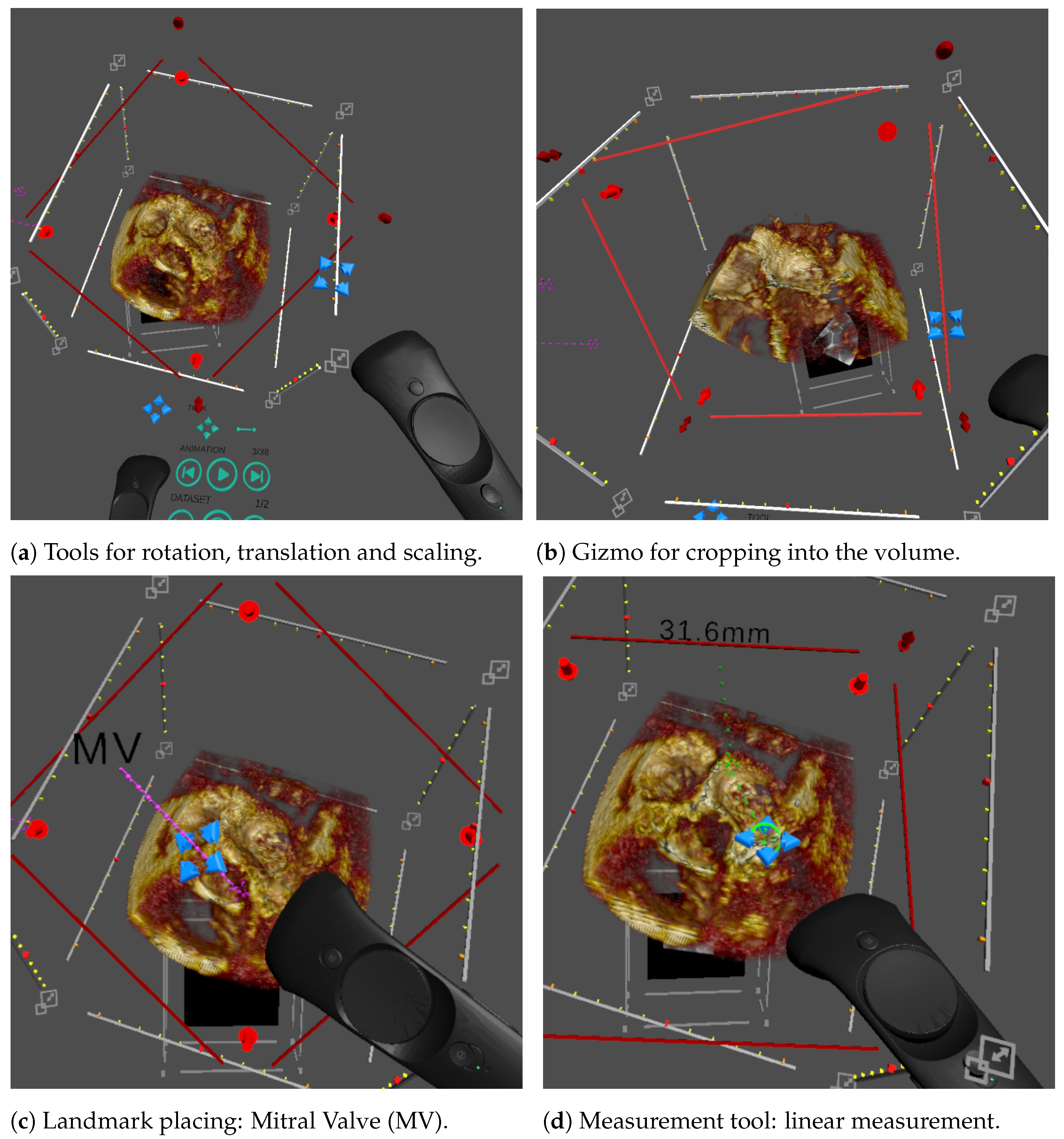 J. Imaging | Free Full-Text | A Virtual Reality System for Improved  Image-Based Planning of Complex Cardiac Procedures | HTML